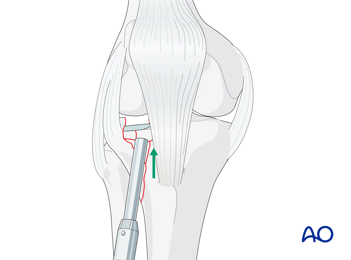 Proximal tibia Lateral plateau split-depression fracture – ORIF conventional plating – Reduction of the lateral articular surface