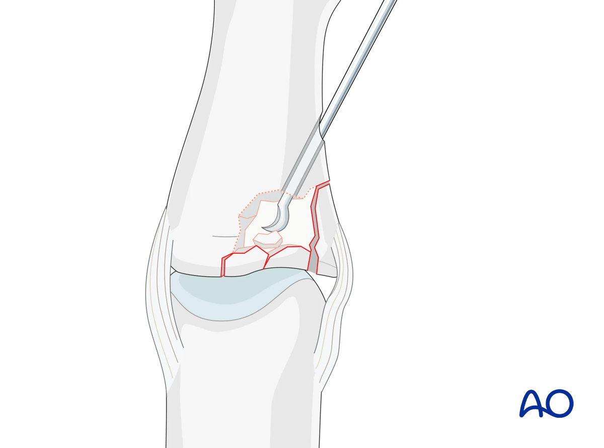 Joint reconstruction of lateral plateau fracture in middle phalangeal base, disimpact fragments using K-wire or dental pick.