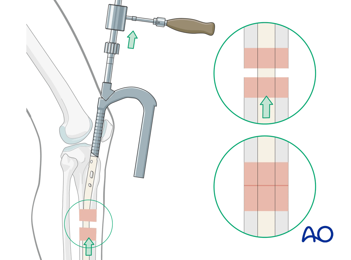Suprapatellar intramedullary nailing, Backslap technique for correction of fragment diastasis