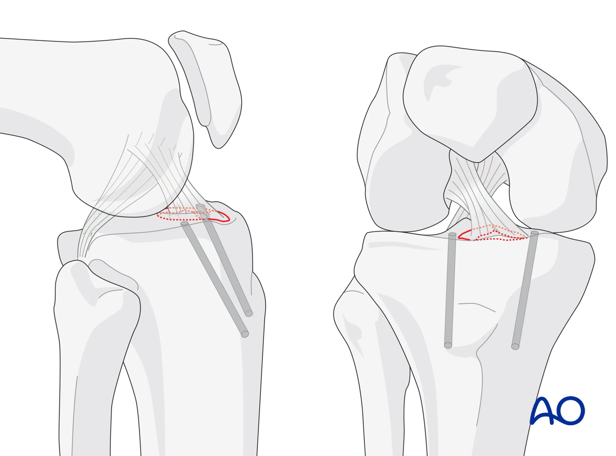 Extraarticular fracture, avulsion of tibial spine: fixation