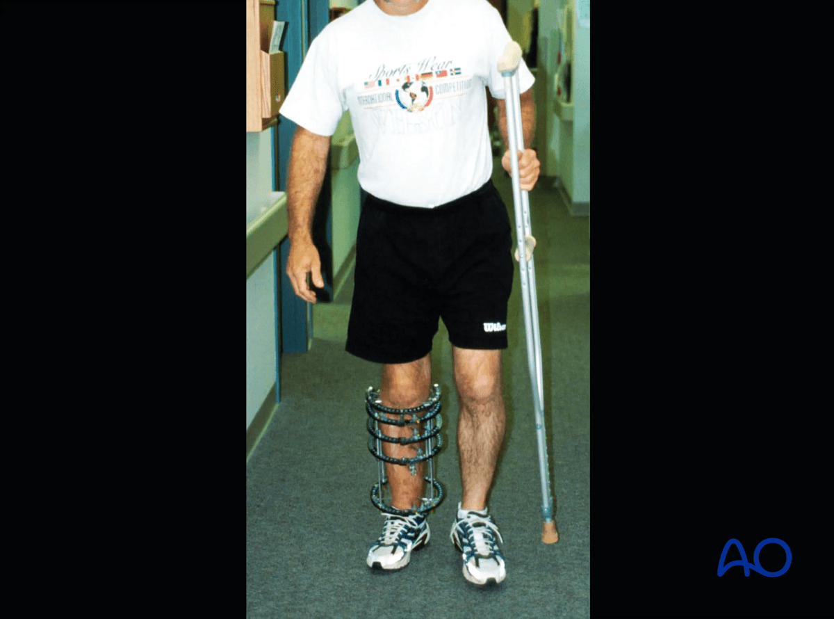 Proximal tibia fracture – ring fixation: patient observed ambulating