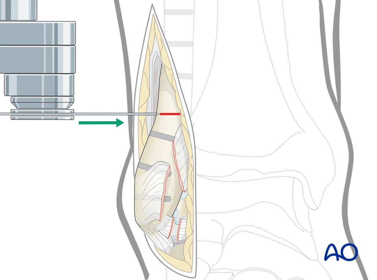 Lateral malleolar osteotomy plan transverse fibular osteotomy 3 cm above joint; use oscillating saw