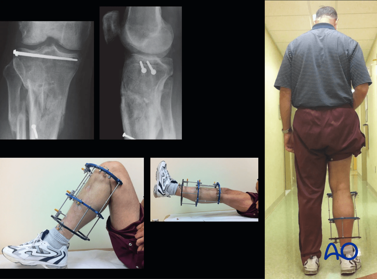 Proximal tibia fracture – ring fixation: the frame was removed at 16 weeks after fracture healing