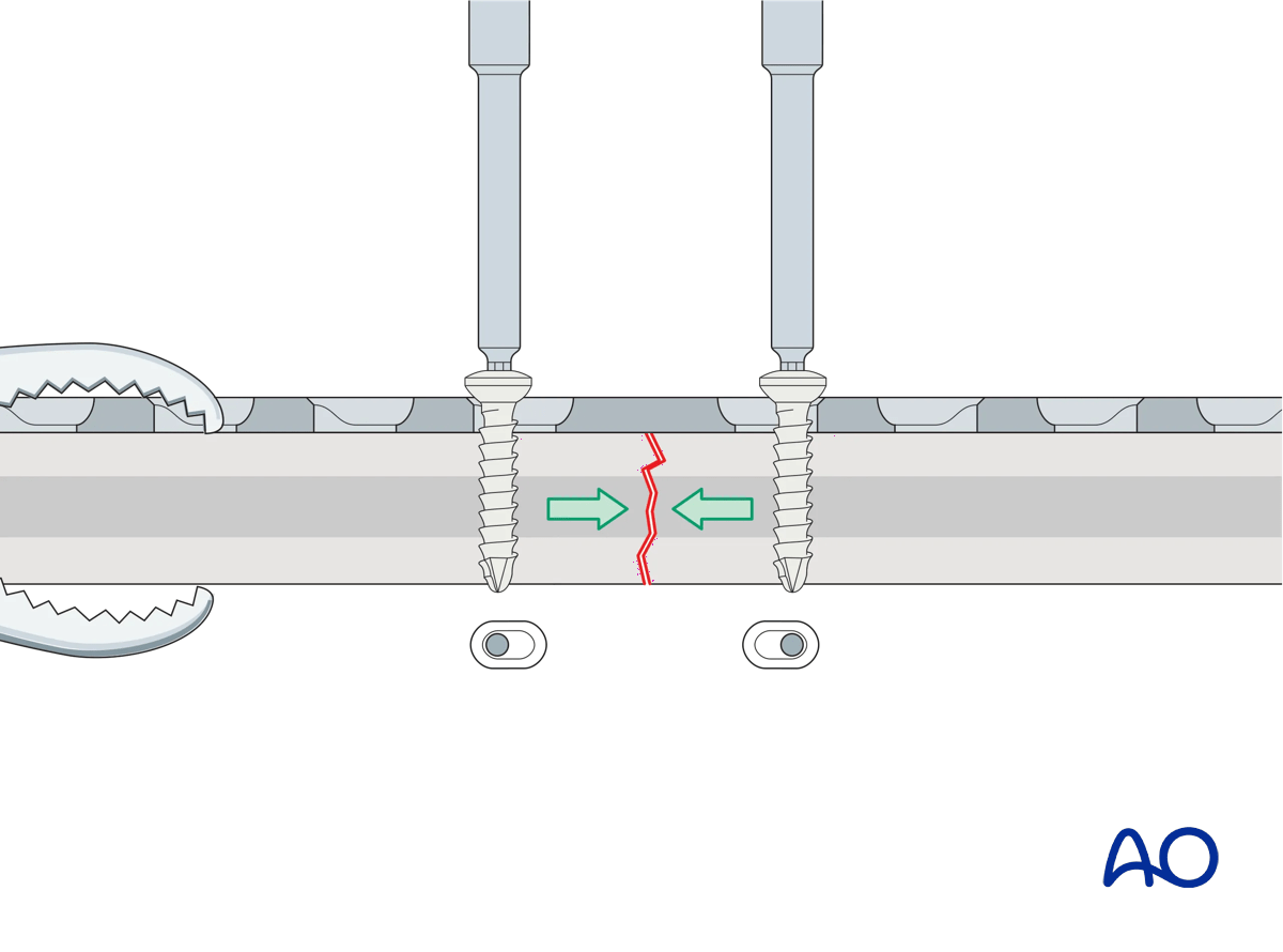 Illustration showing a screw inserted in compression mode in the opposite fragment, with gradual tightening of screws by alternating between sides to maintain reduction.