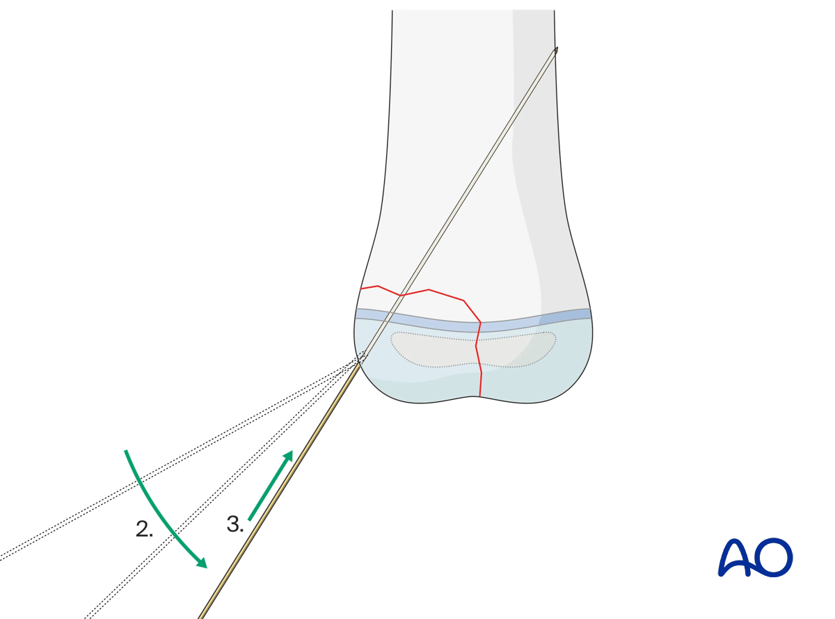 Adjusting angulation of K-wire direction