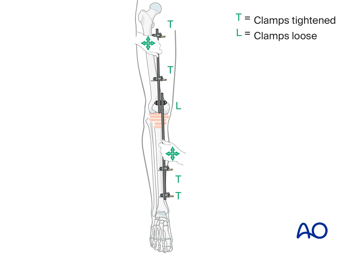 Tibia: temporary bridging external fixator: reduction and fixation