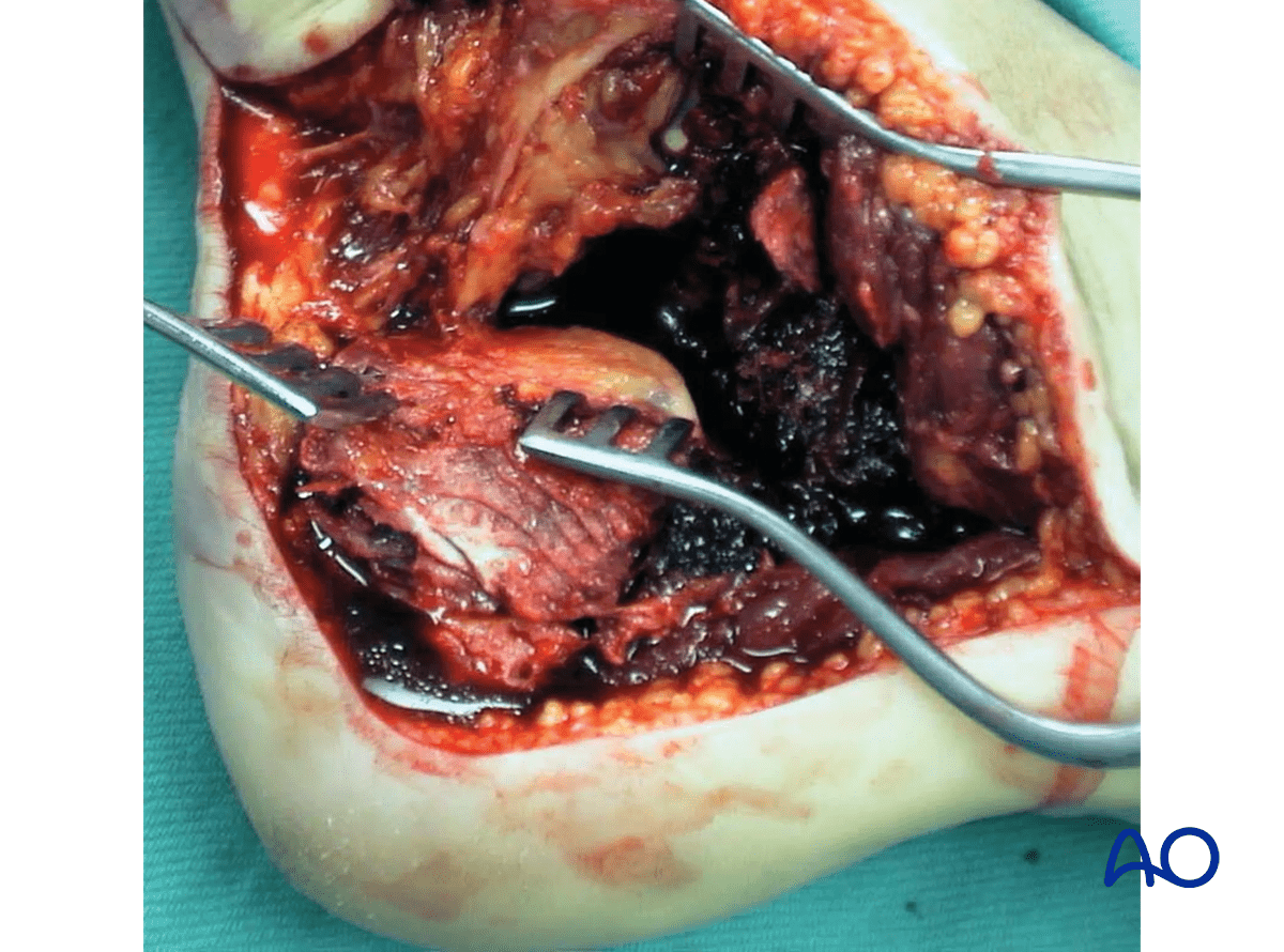 Extended lateral approach to the calcaneus: retractor or sutures aid flap; avoid fibular K-wire retraction
