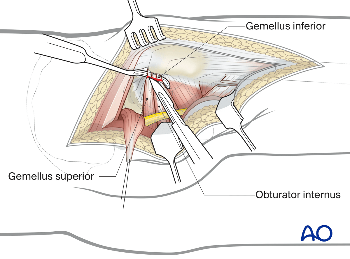 Access to the lesser sciatic notch in a Kocher-Langenbeck approach to the hip