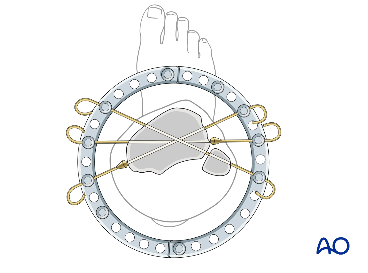 Proximal tibia fracture – ring fixation: fixation of the articular block