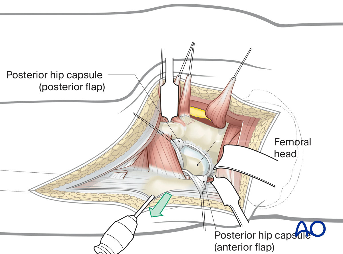 Illustration of Kocher-Langenbeck approach: using Schanz screw or skeletal traction for hip joint distraction.