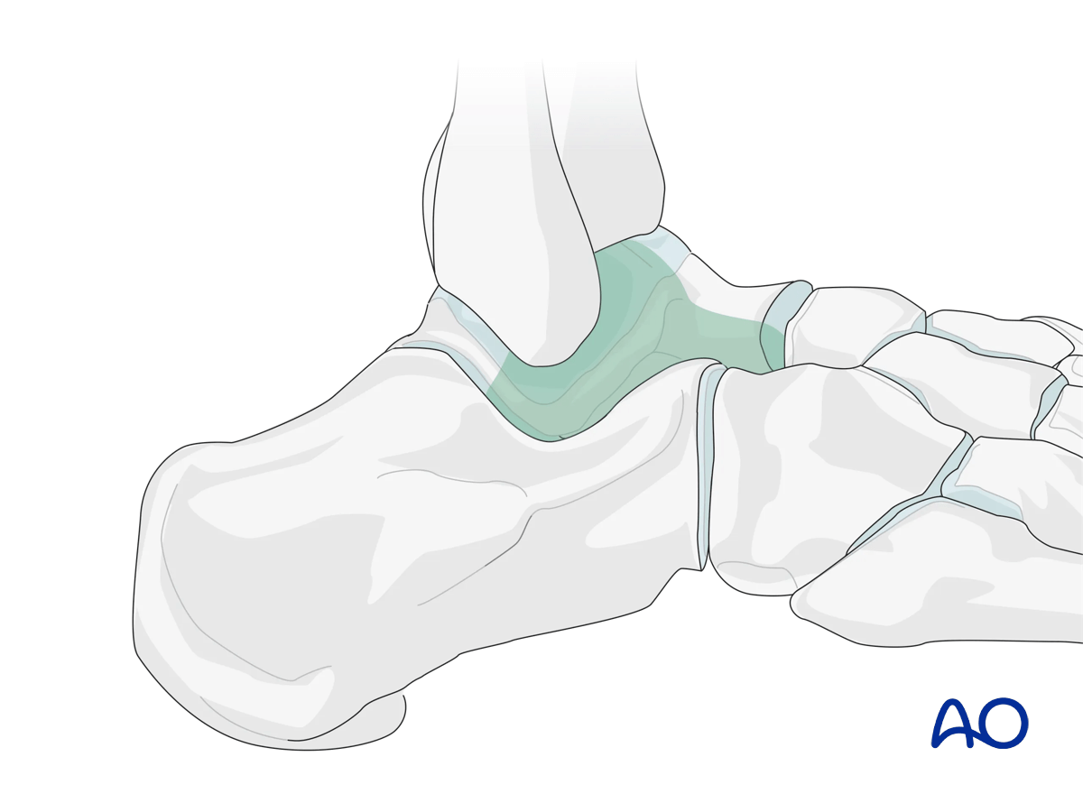 Talus regions visible via anterolateral approaches