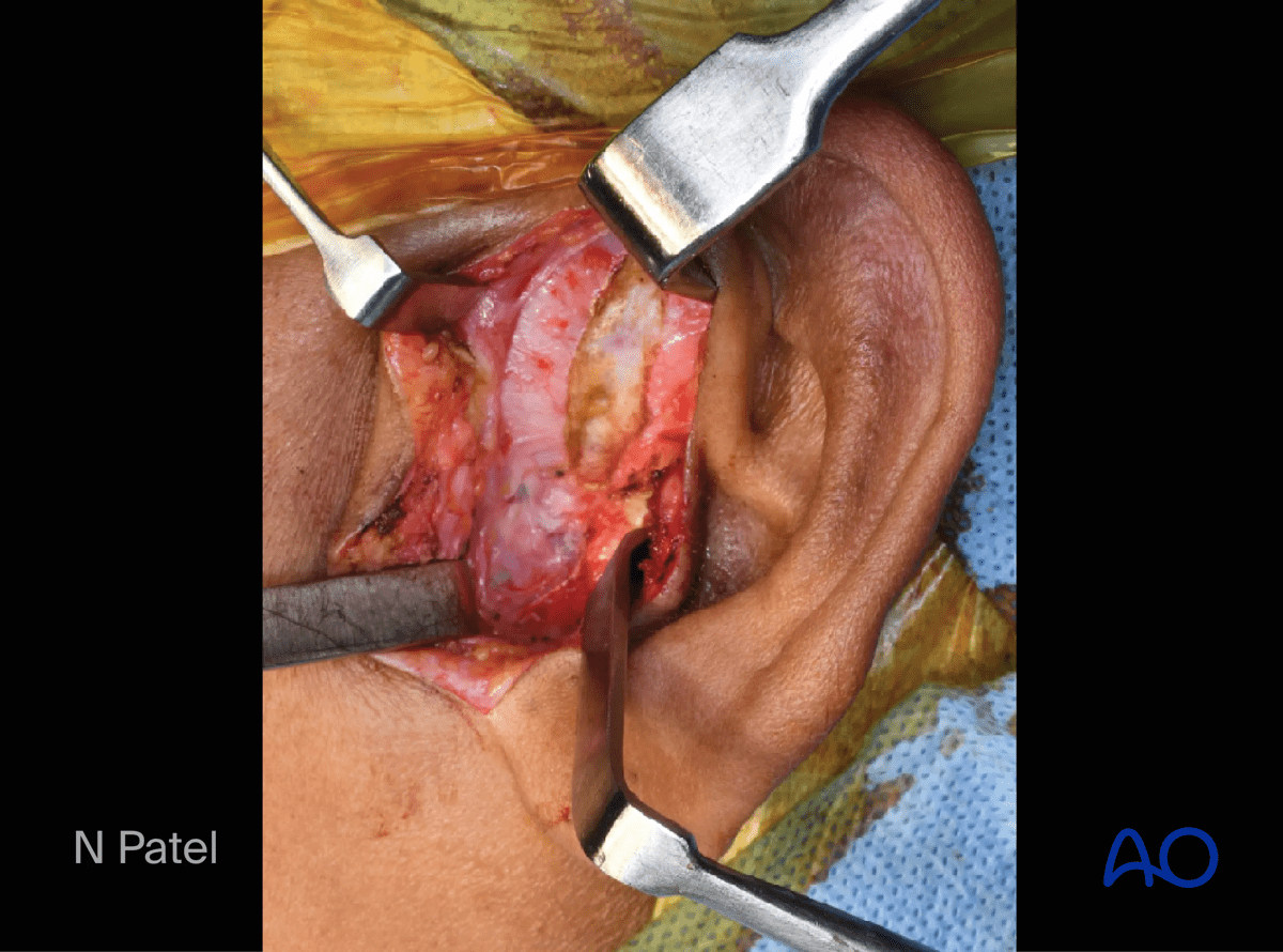 Endaural approach to condyle: Incising the temporalis fascia