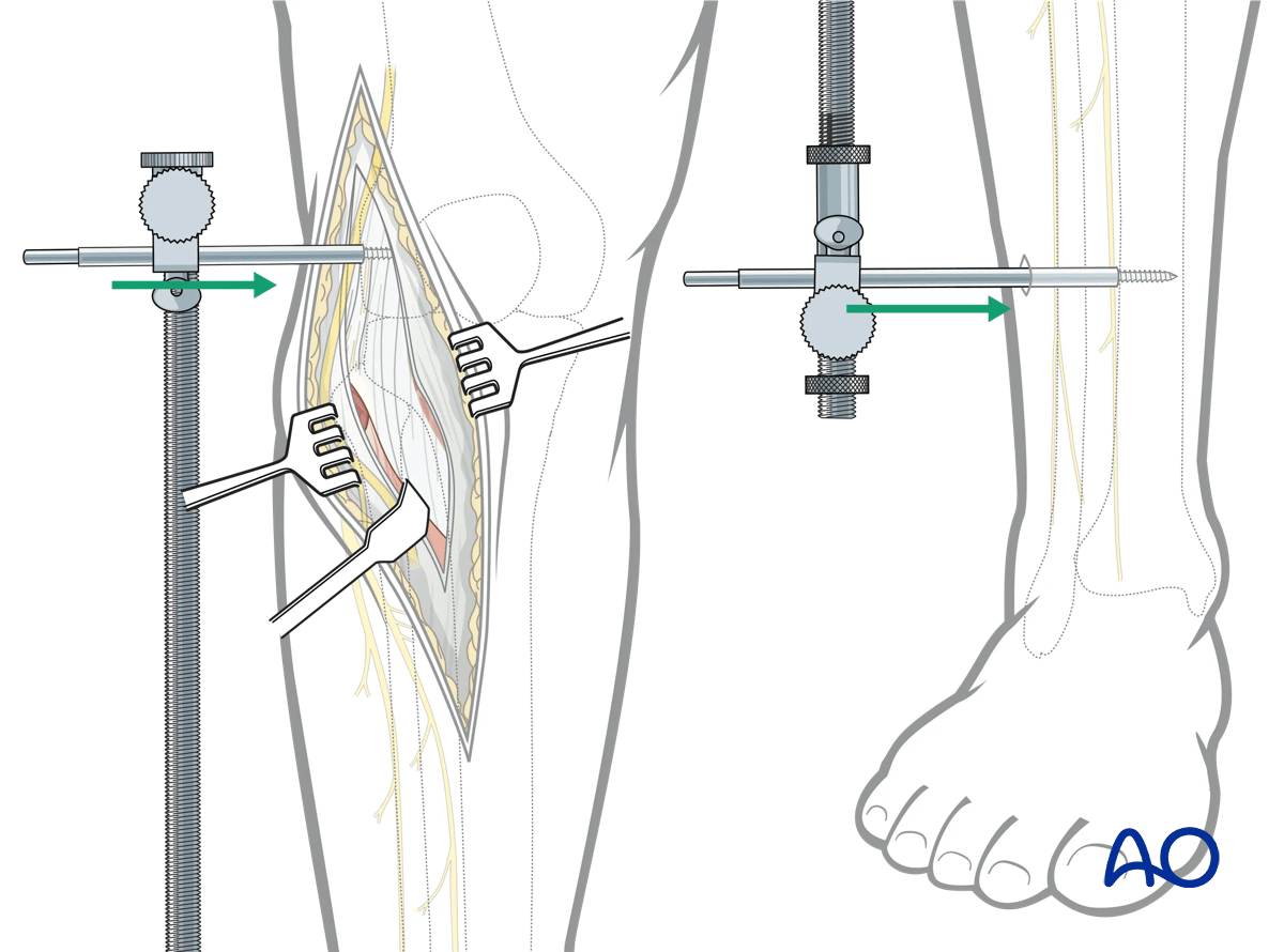 Anterolateral approach to the proximal tibia: application of the universal distractor