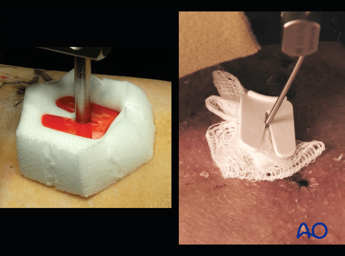 Proximal tibia fracture – ring fixation: examples of compressive dressings used to limit skin motion