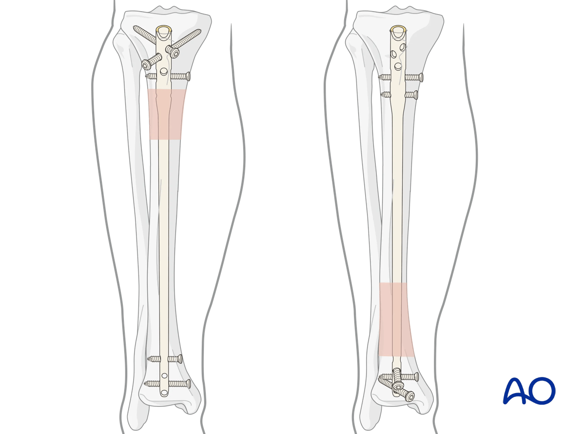 Suprapatellar intramedullary nailing, screw insertion