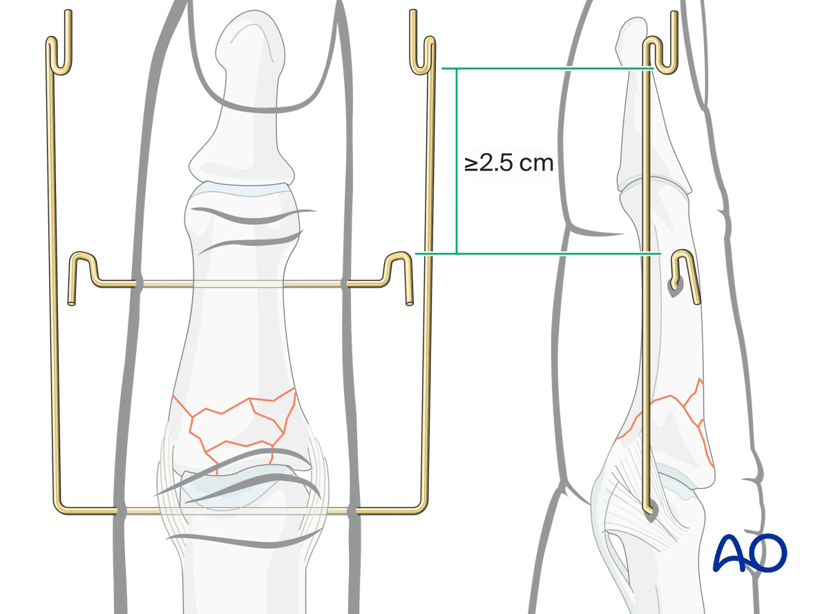 Dynamic external fixation: Create hooks, open proximally, on each end of second K-wire close to skin insertion; hooks on first K-wire 2.5 cm distal.