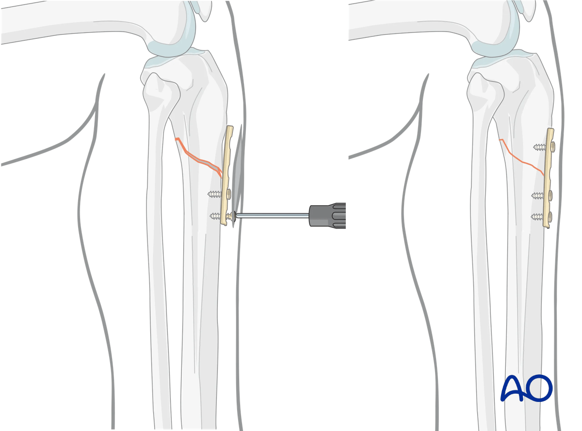 Lateral parapatellar intramedullary nailing of the tibial shaft, Reduction and preliminary fixation