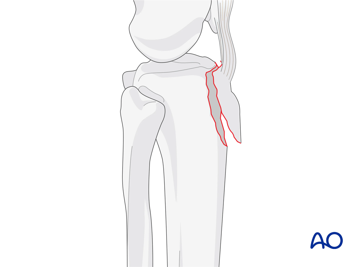 Extraarticular fracture avulsion of tibial tubercle