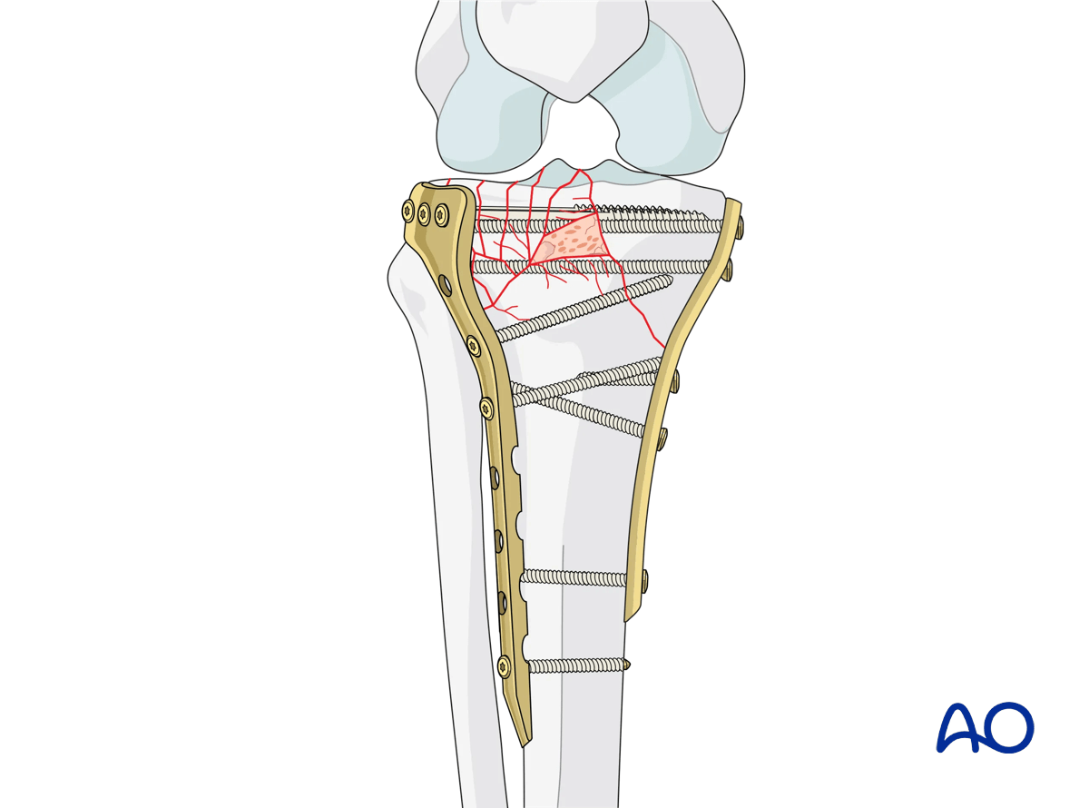 Proximal tibia: Complete articular fracture with fragmentary lateral plateau. ORIF - Conventional plating, final osteosynthesis