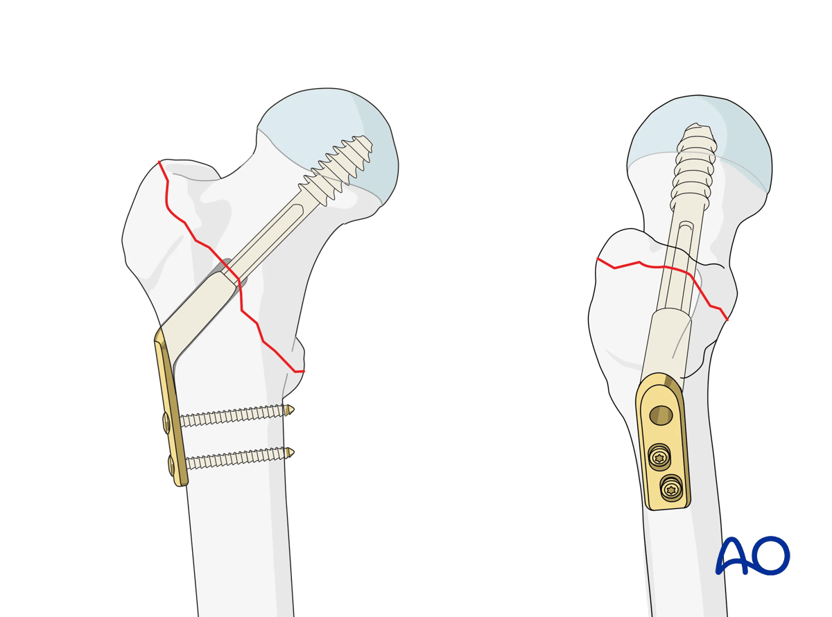 Sliding hip screw (DHS) for the management of a simple two-part pertrochanteric fracture