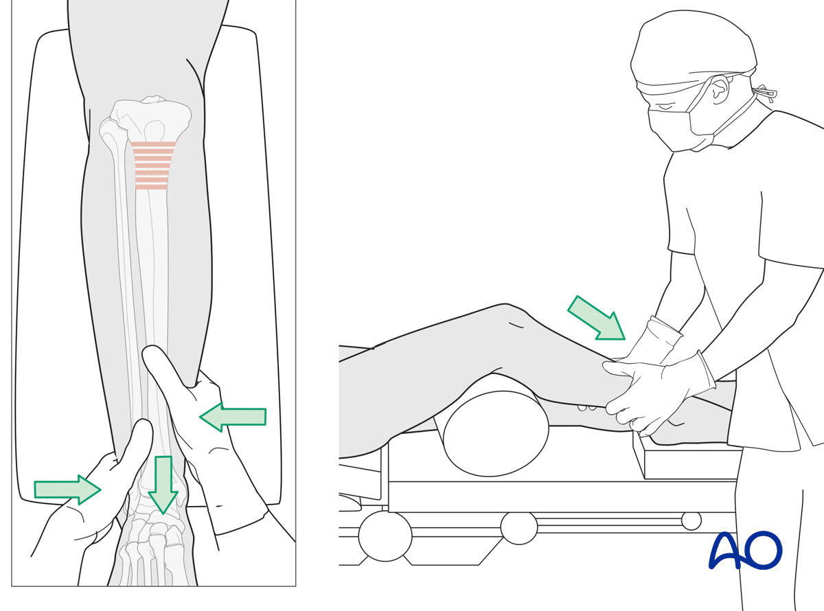 Suprapatellar intramedullary nailing, manual traction