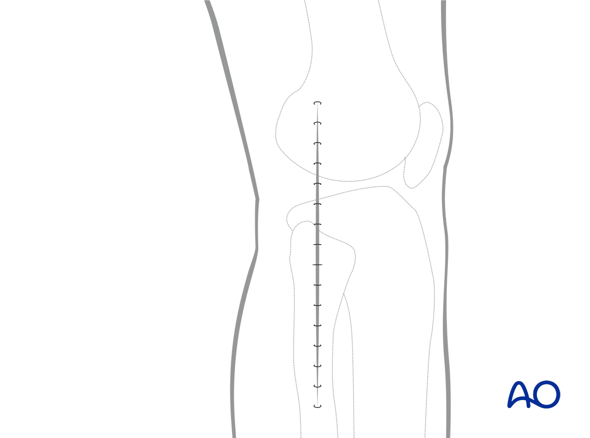 Straight lateral approach, wound closure