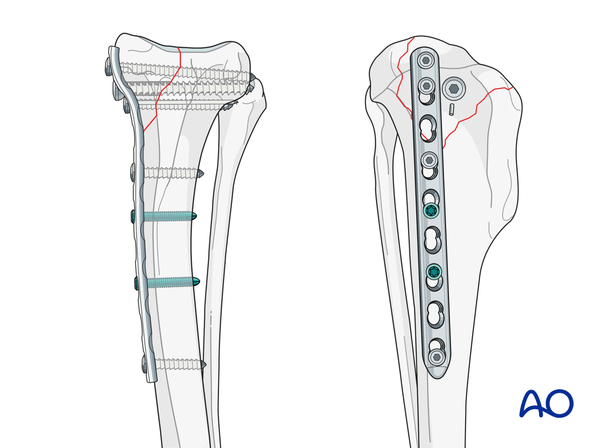 Illustration showing buttress plates supplementing lag screw fixation for partial articular fractures in metaphyseal regions.