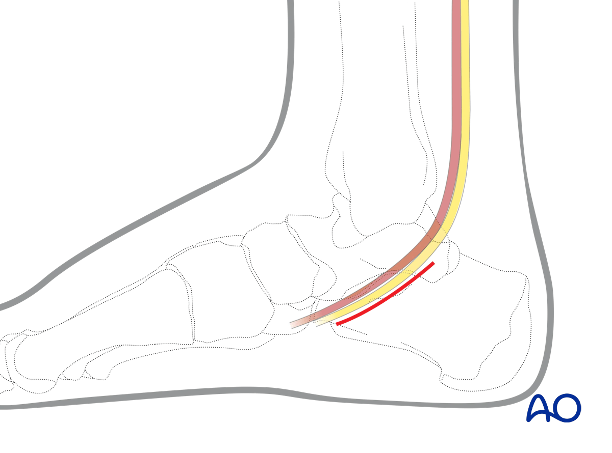 Medial approach to the calcaneus for sustentacular fractures and medial wall exposure. Medial approach to the calcaneus