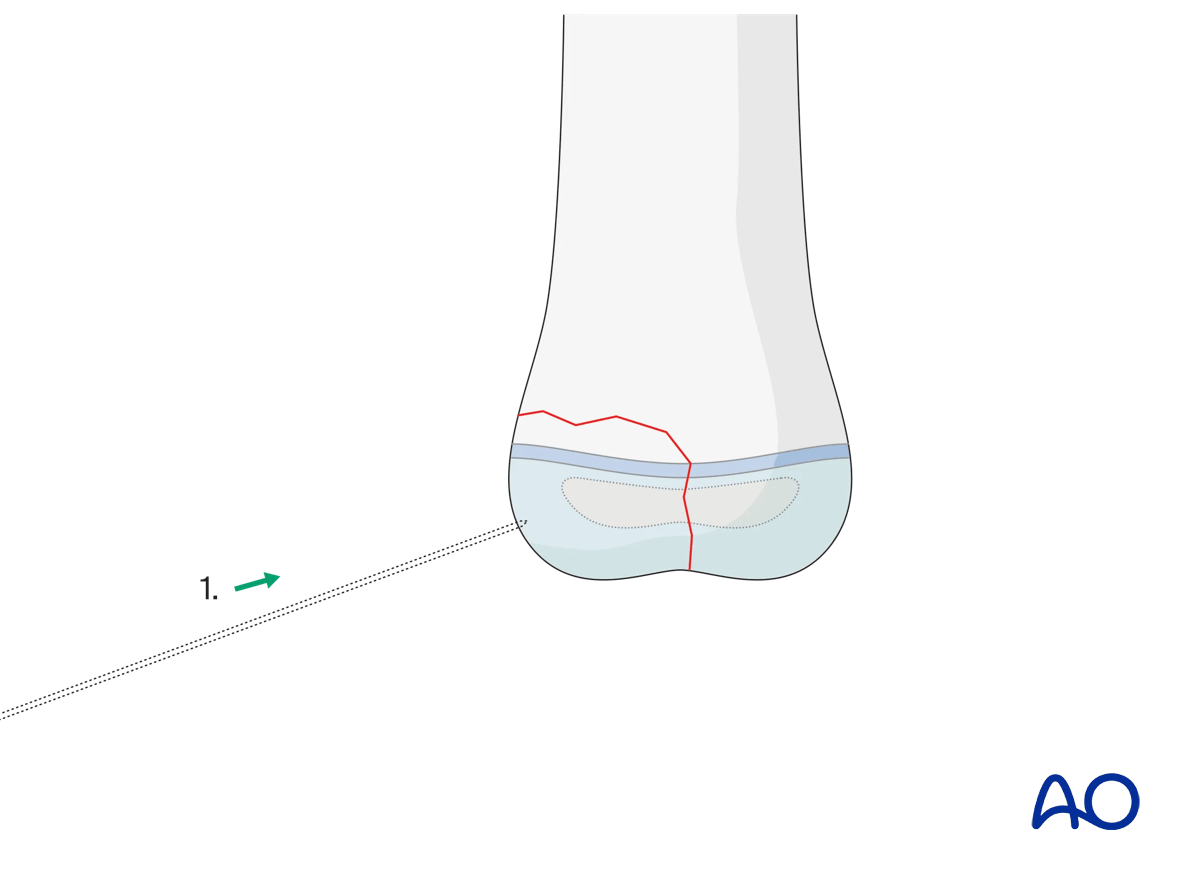 Orthogonal initial K-wire insertion