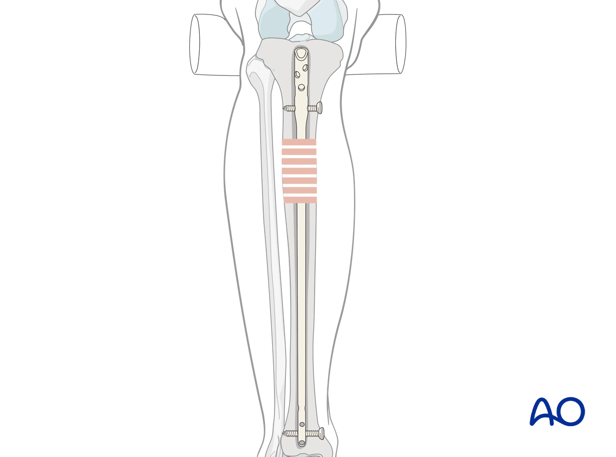 Suprapatellar intramedullary nailing,
