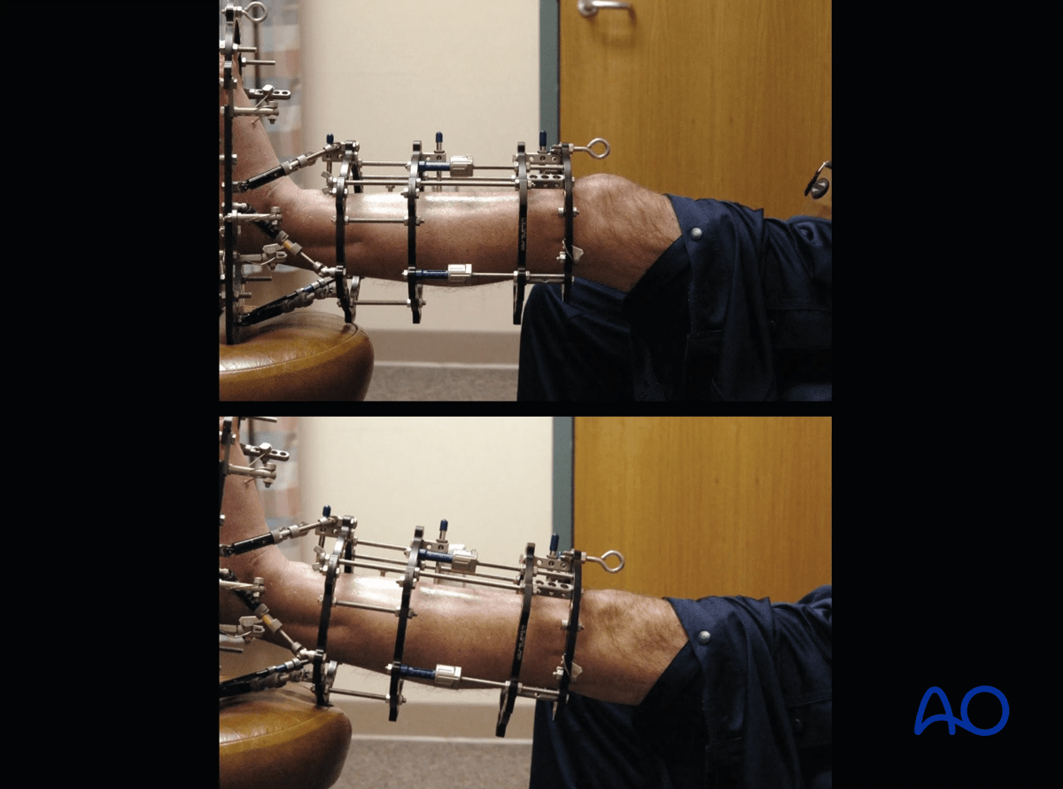 Proximal tibia fracture – ring fixation: terminal knee extension exercises