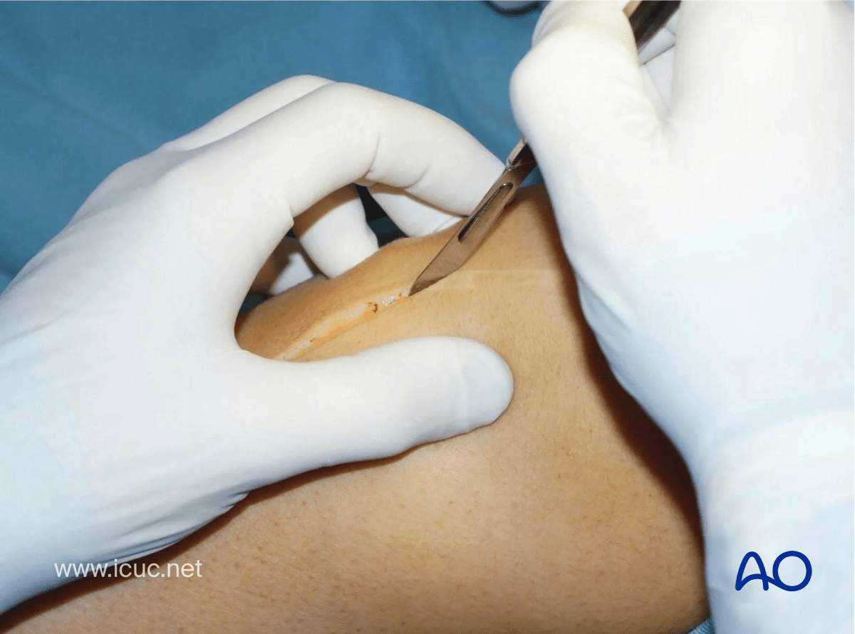 Avulsion of tibial spine - medial parapatellar incision