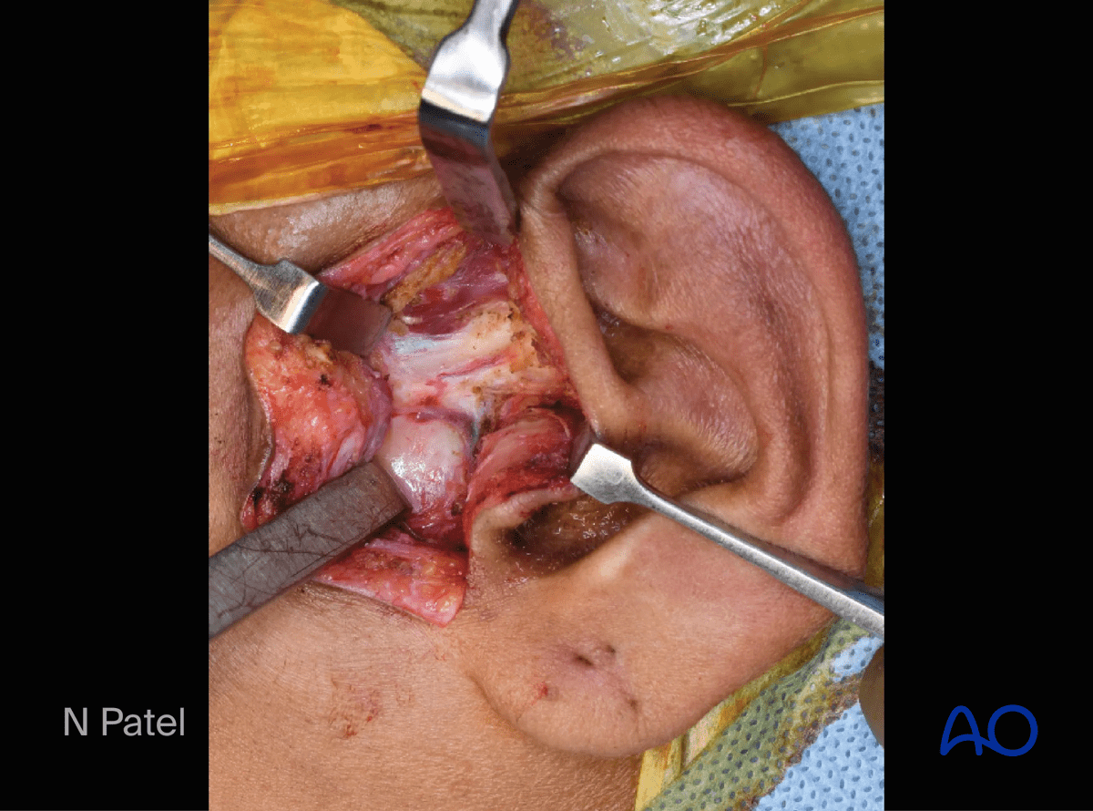 Endaural approach to condyle: Raise the periosteum off the zygomatic arch
