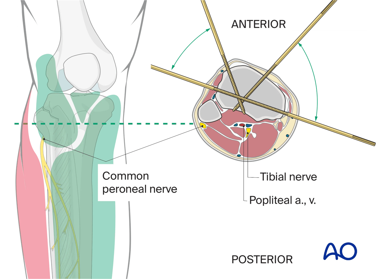 Safe zones in the proximal tibia for pin and wire insertion