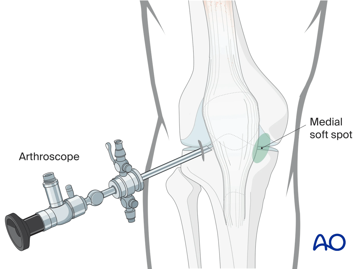 Arthroscopic approach to the knee, Anteromedial port