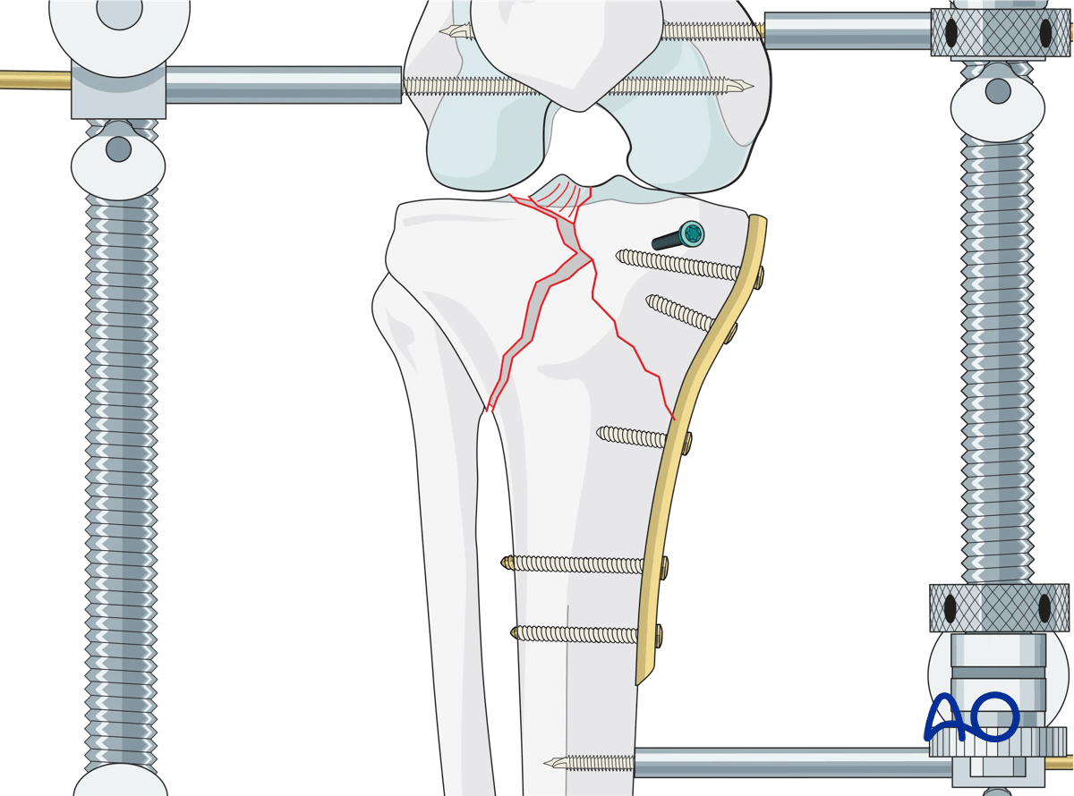 Proximal tibia - Complete articular fracture with fragmentary medial plateau: application of medial plate