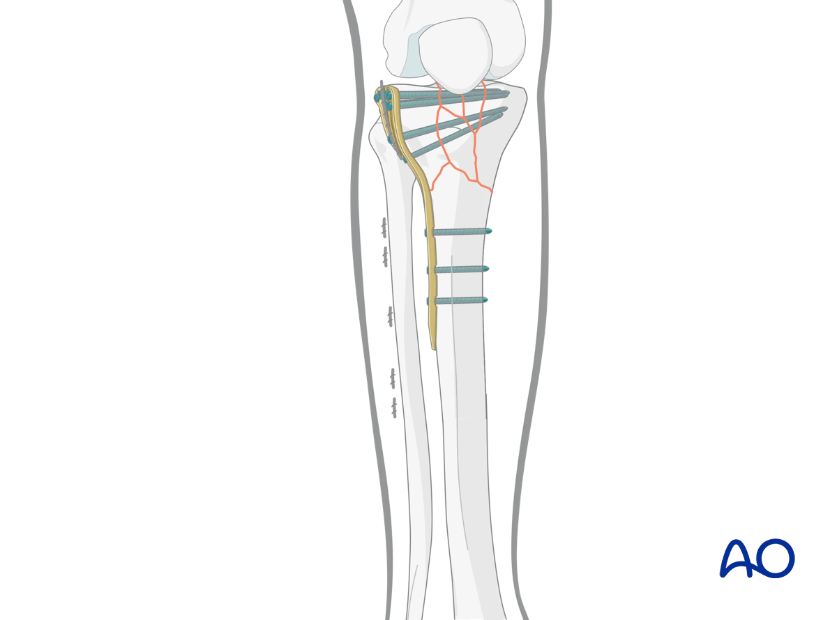 Proximal tibia: complete articular fracture - Angular stable plating – finalized reduction and screw placement