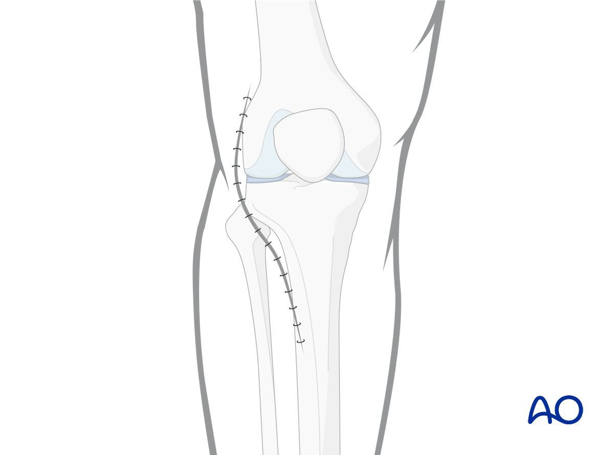 Anterolateral approach to the proximal tibia: wound closure