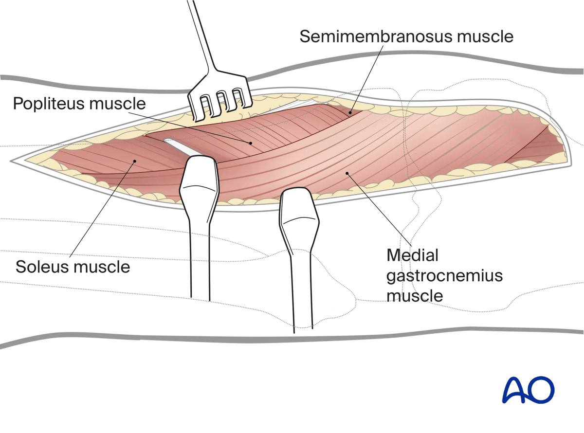 Prone posteromedial approach to the proximal tibia