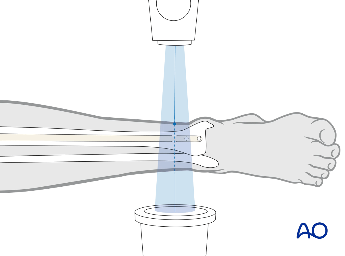 Suprapatellar intramedullary nailing, Distal interlocking with fluoroscopic guidance