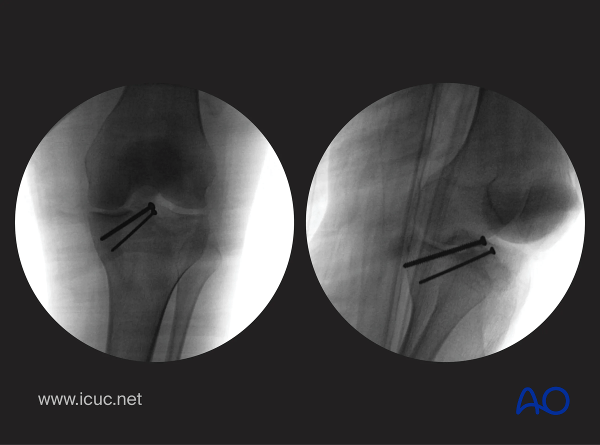 Avulsion of tibial spine – intraoperative check x-rays in two views