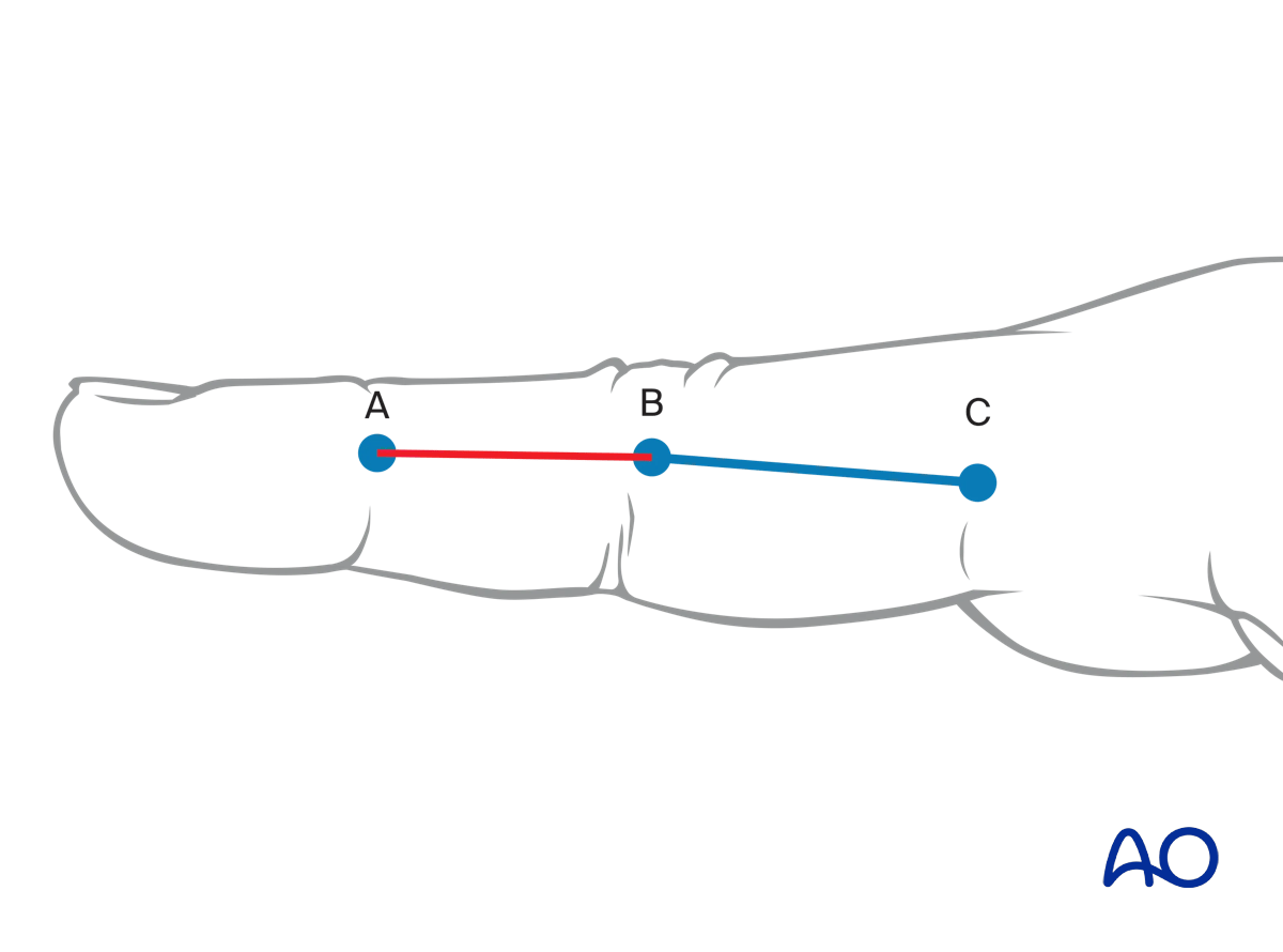Midaxial approach to the middle phalanx