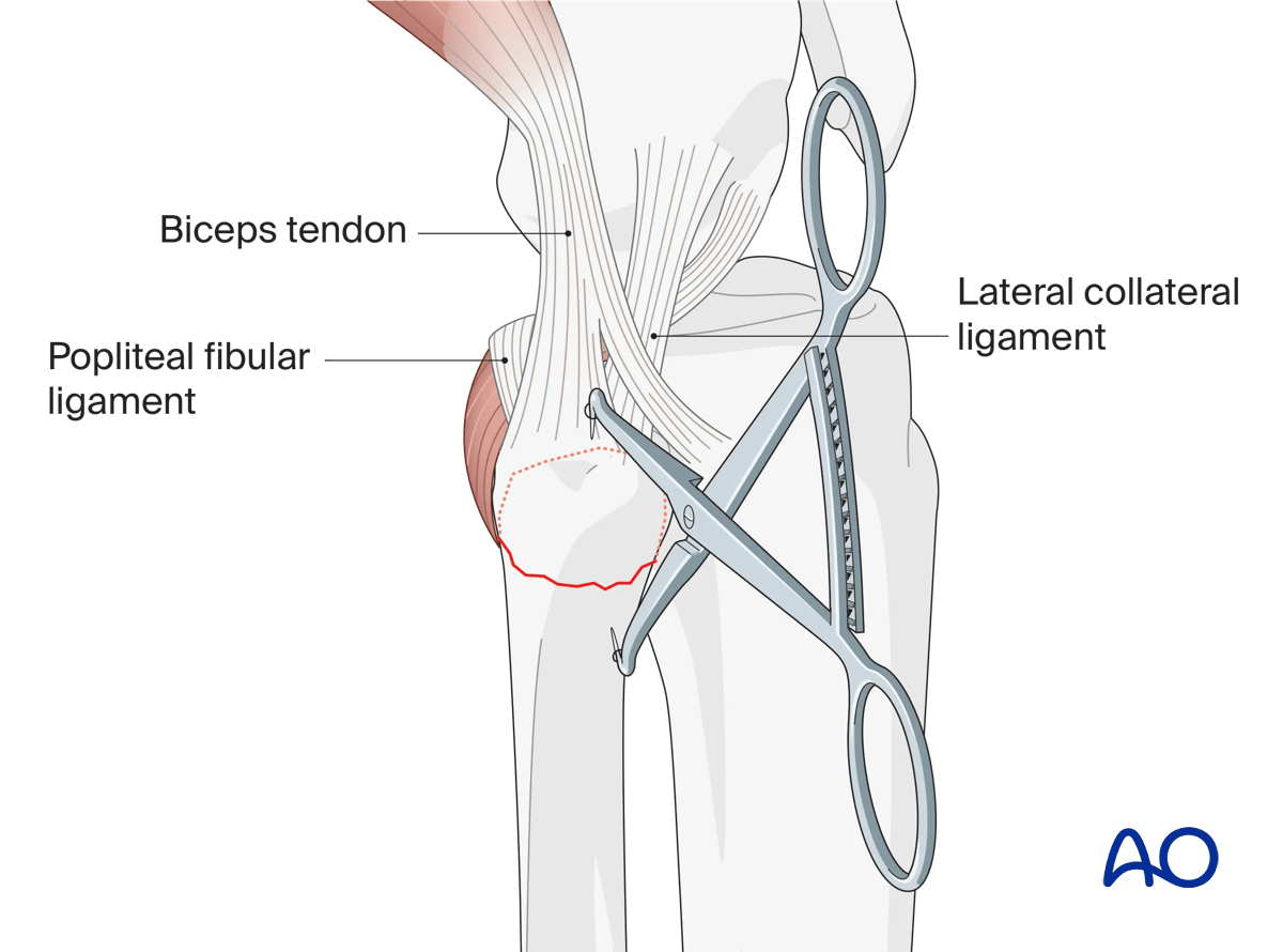 Extraarticular avulsion of fibular head: preliminary reduction