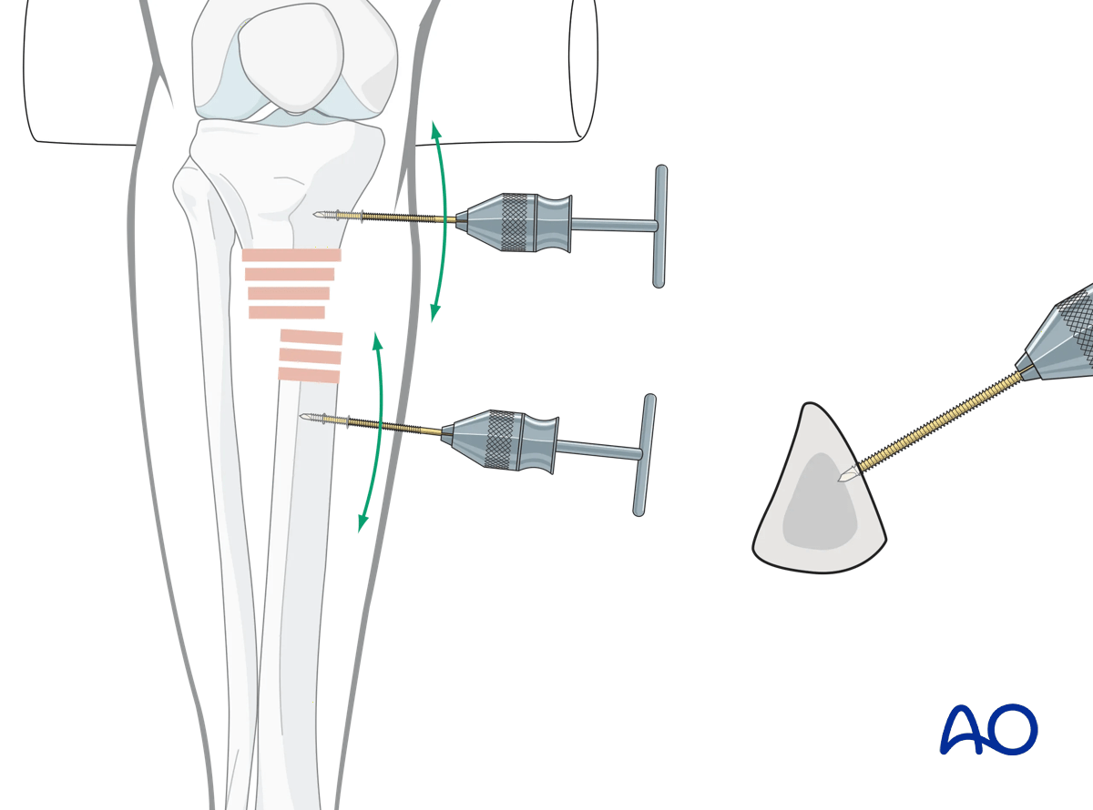 Suprapatellar intramedullary nailing, joysticks
