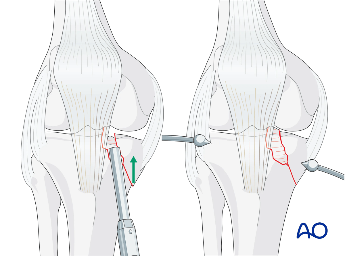 ORIF - Conventional plating, reduction of the medial articular surface