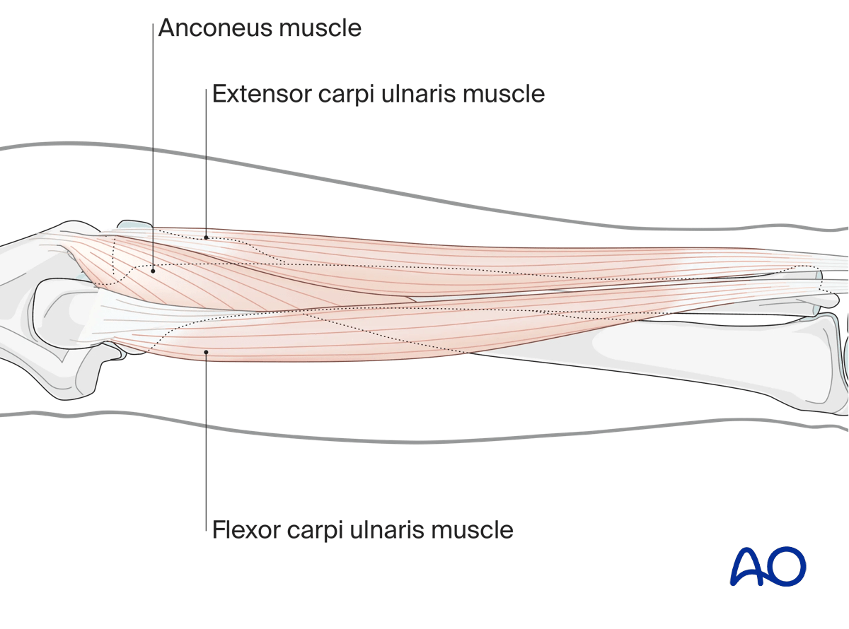 Safe zones for ulnar pin insertion are along the whole shaft between the extensor carpi ulnaris and the flexor carpi ulnaris
