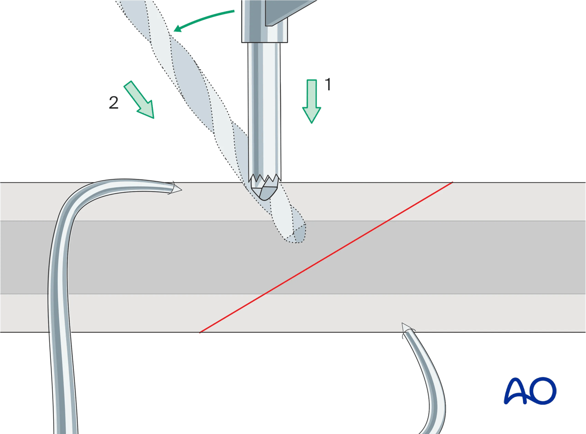 Pearl for drilling obliquely to the surface of the bone