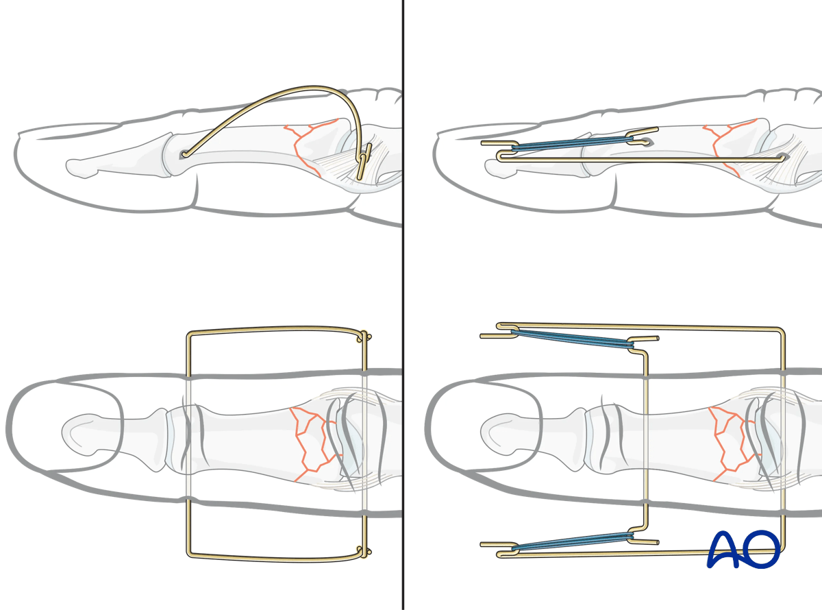 Dynamic external fixation: Suzuki type fixator frame allows early mobilization for multifragmentary articular fractures.