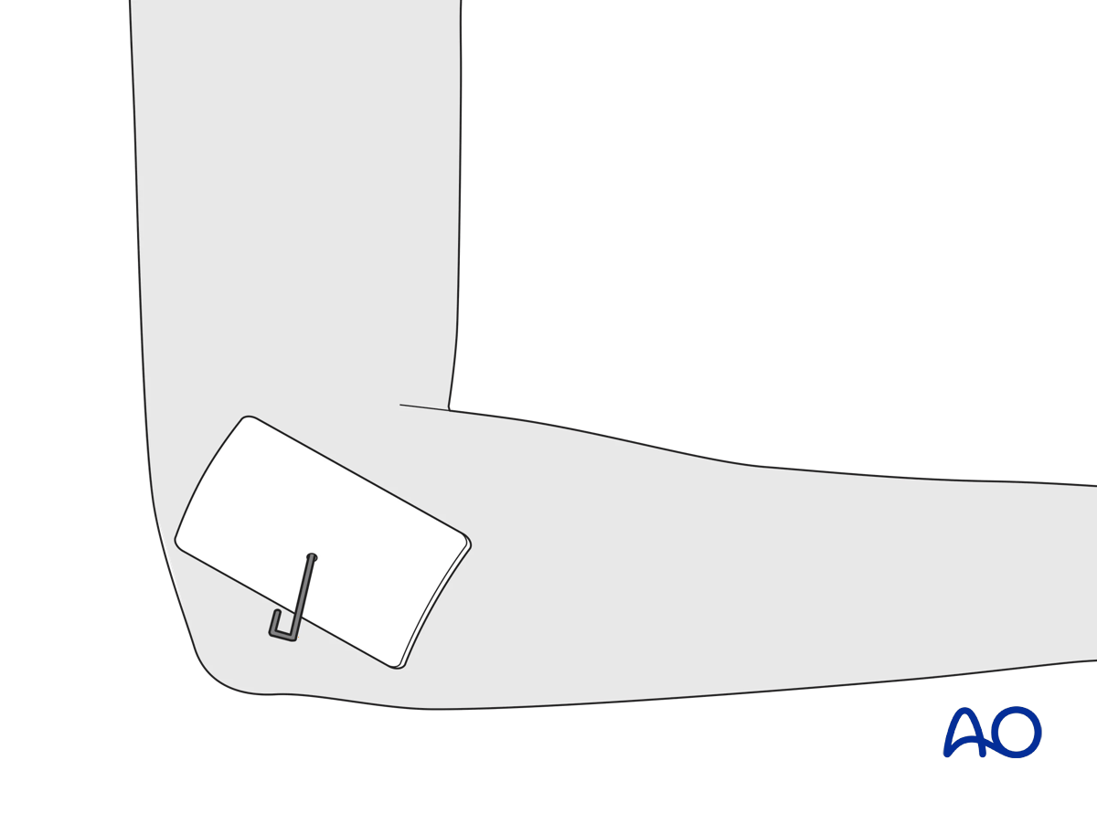 Protruding free end of K-wire
