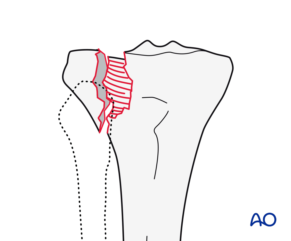 Lateral plateau split-depression fracture